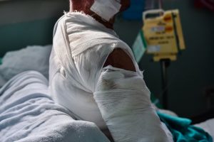 burn injury workers compensation 